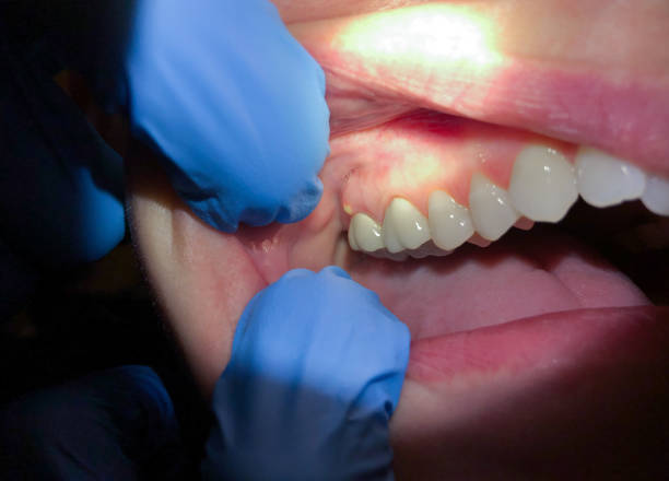 Best Emergency Dental Care for Sports Injuries in Ashville, AL